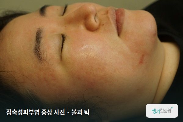 볼과 턱에 생긴 접촉성피부염 증상 사진 — 접촉성피부염 증상 사진 · 볼과 턱