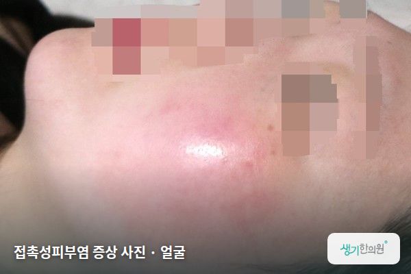 얼굴에 생긴 접촉성피부염 증상 사진