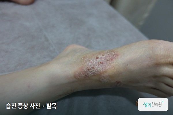 발목에 생긴 습진 증상 사진 — 습진 증상 사진 · 발목