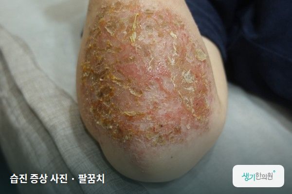 팔꿈치에 생긴 습진 증상 사진 — 습진 증상 사진 · 팔꿈치