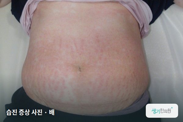 배에 생긴 습진 증상 사진 — 습진 증상 사진 · 배