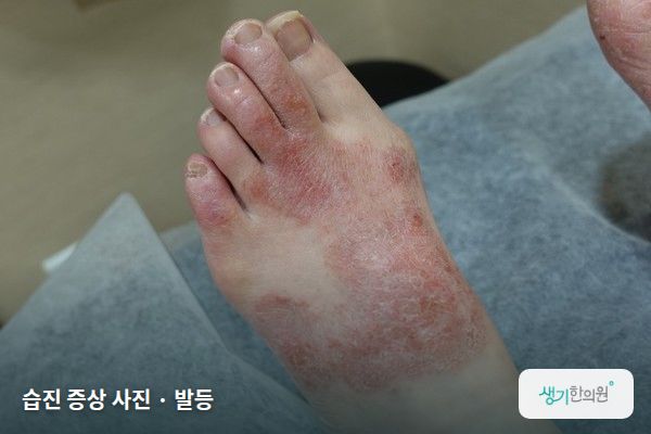 발등에 생긴 습진 증상 사진 — 습진 증상 사진 · 발등