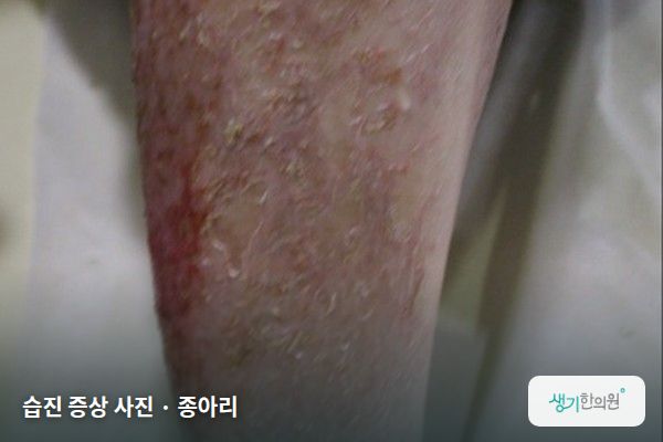 종아리에 생긴 습진 증상 사진 — 습진 증상 사진 · 종아리
