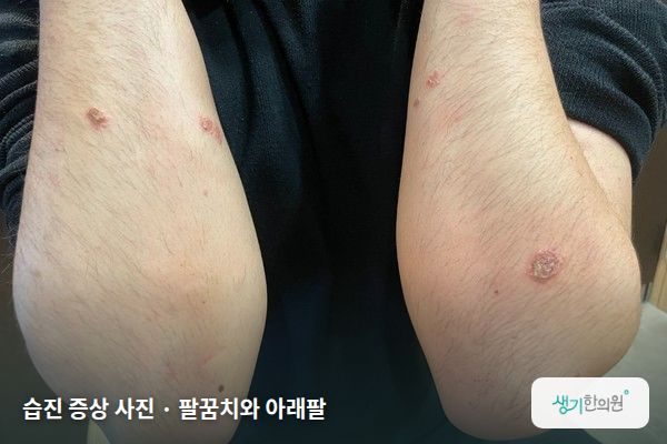 팔꿈치와 아래팔에 생긴 습진 증상 사진 — 습진 증상 사진 · 팔꿈치와 아래팔