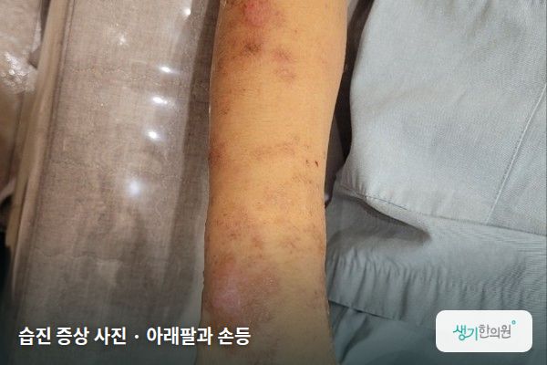 아래팔과 손등에 생긴 습진 증상 사진 — 습진 증상 사진 · 아래팔과 손등