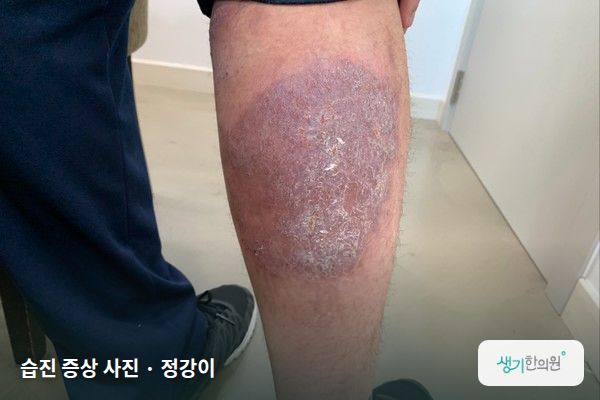 정강이에 생긴 습진 증상 사진 — 습진 증상 사진 · 정강이