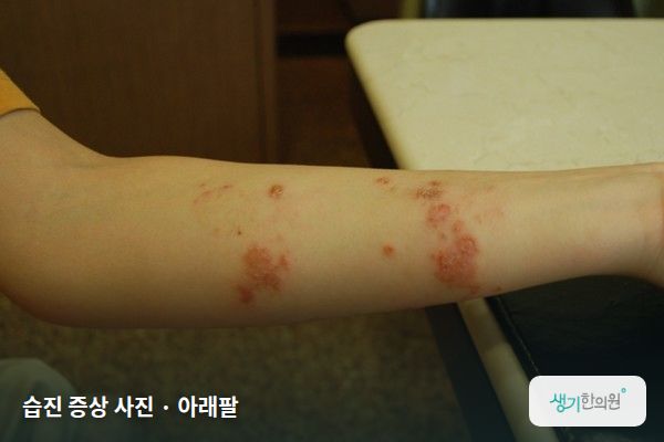 아래팔에 생긴 습진 증상 사진 — 습진 증상 사진 · 아래팔