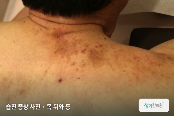 목 뒤와 등에 생긴 습진 증상 사진 — 습진 증상 사진 · 목 뒤와 등