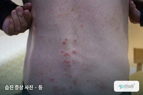 등에 생긴 습진 증상 사진 — 습진 증상 사진 · 등