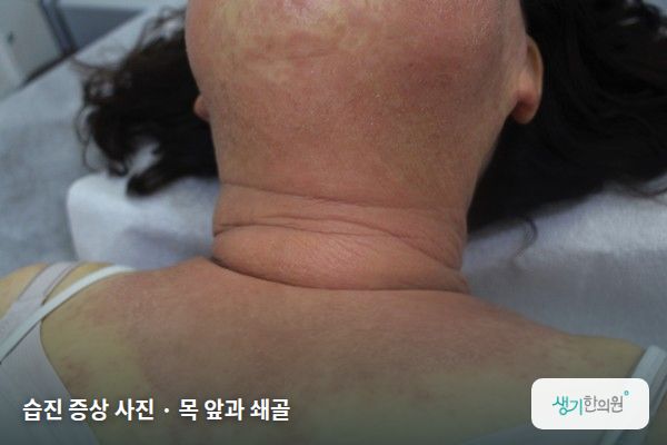 목 앞과 쇄골에 생긴 습진 증상 사진 — 습진 증상 사진 · 목 앞과 쇄골