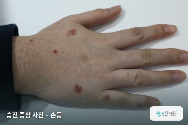 손등에 생긴 습진 증상 사진 — 습진 증상 사진 · 손등