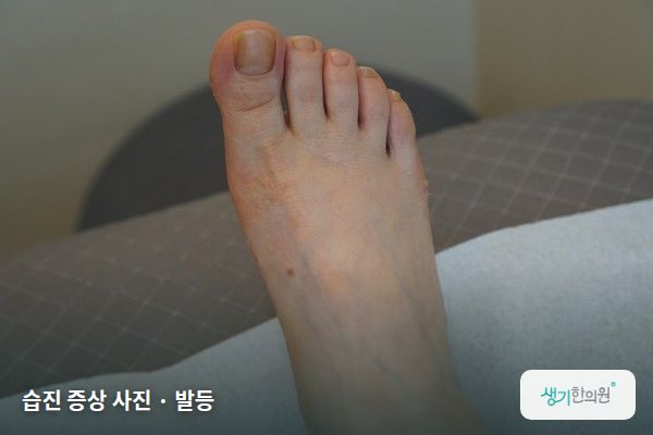 발등에 생긴 습진 증상 사진 — 습진 증상 사진 · 발등