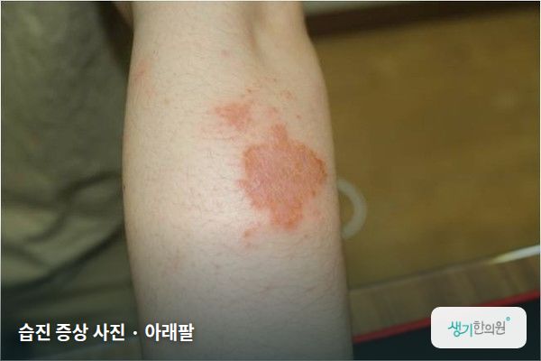 아래팔에 생긴 습진 증상 사진 — 습진 증상 사진 · 아래팔