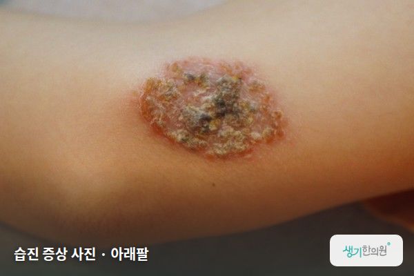 아래팔에 생긴 습진 증상 사진 — 습진 증상 사진 · 아래팔