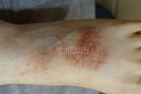 발등의 습진 증상 사진