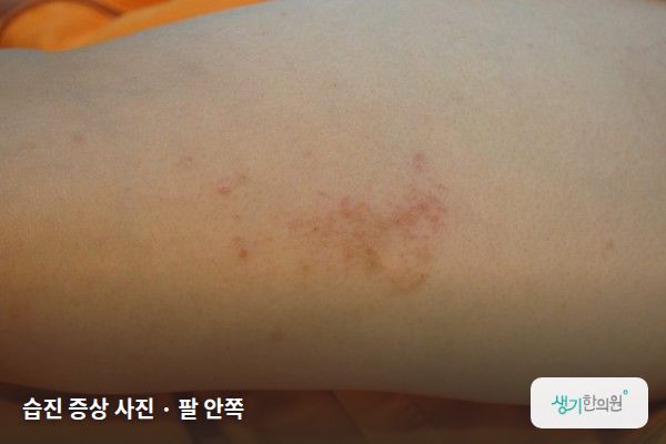팔 안쪽에 생긴 습진 증상 사진 — 습진 증상 사진 · 팔 안쪽