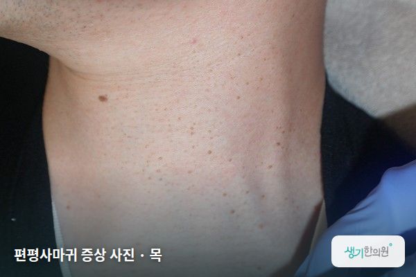 목에 생긴 편평사마귀 증상 사진 — 편평사마귀 증상 사진 · 목