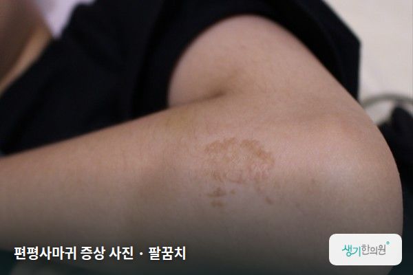 팔꿈치에 생긴 편평사마귀 증상 사진 — 편평사마귀 증상 사진 · 팔꿈치