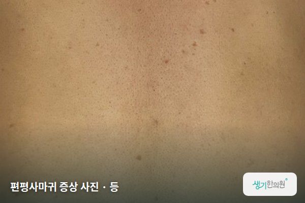 등에 생긴 편평사마귀 증상 사진 — 편평사마귀 증상 사진 · 등
