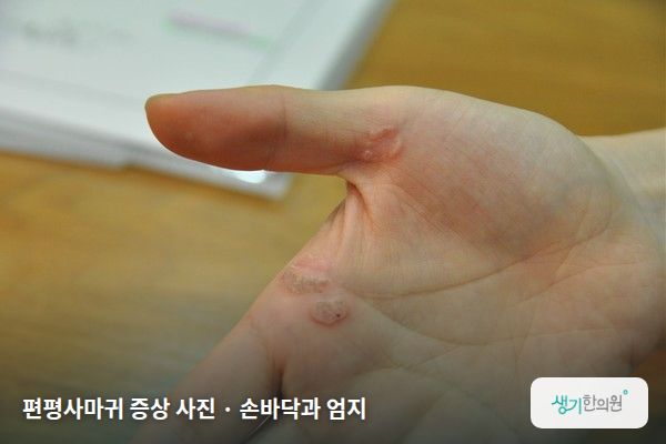 손바닥과 엄지에 생긴 편평사마귀 증상 사진 — 편평사마귀 증상 사진 · 손바닥과 엄지