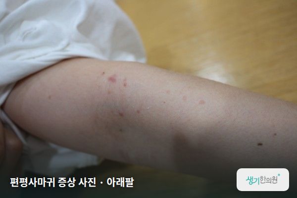 아래팔에 생긴 편평사마귀 증상 사진 — 편평사마귀 증상 사진 · 아래팔