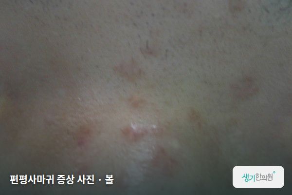 볼에 생긴 편평사마귀 증상 사진 — 편평사마귀 증상 사진 · 볼