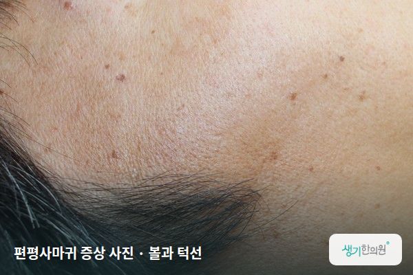 볼과 턱선에 생긴 편평사마귀 증상 사진 — 편평사마귀 증상 사진 · 볼과 턱선