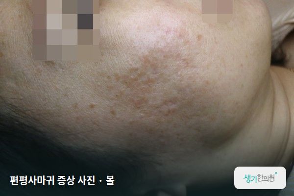 볼에 생긴 편평사마귀 증상 사진 — 편평사마귀 증상 사진 · 볼