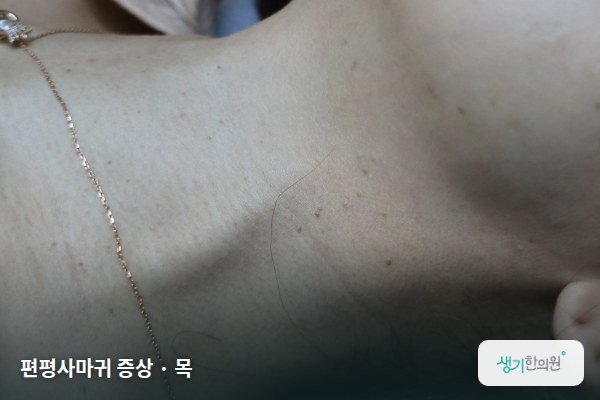 목에 생긴 편평사마귀 증상 사진