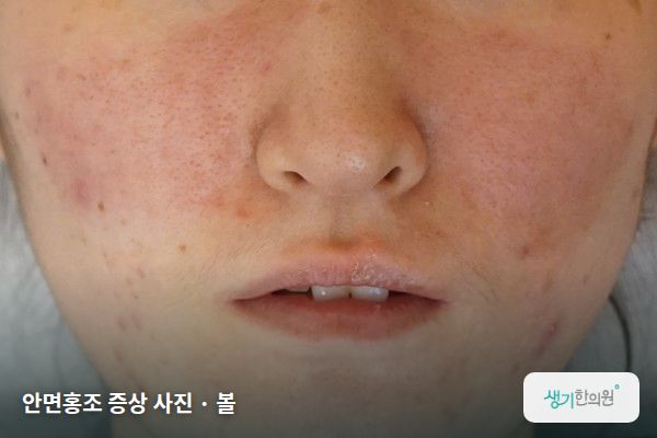 볼에 생긴 안면홍조 증상 사진 — 안면홍조 증상 사진 · 볼