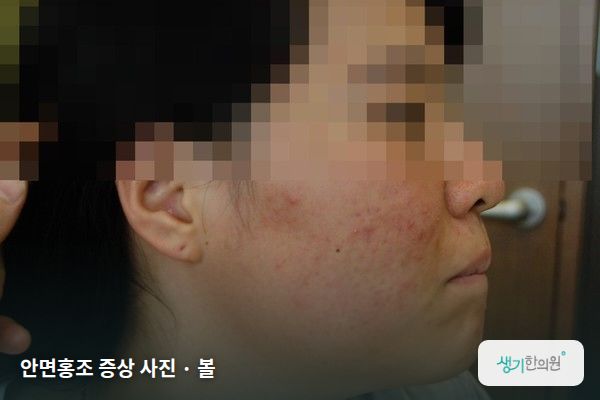볼에 생긴 안면홍조 증상 사진 — 안면홍조 증상 사진 · 볼