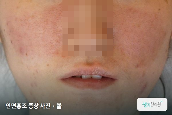볼에 생긴 안면홍조 증상 사진 — 안면홍조 증상 사진 · 볼