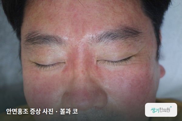 볼과 코에 생긴 안면홍조 증상 사진 — 안면홍조 증상 사진 · 볼과 코
