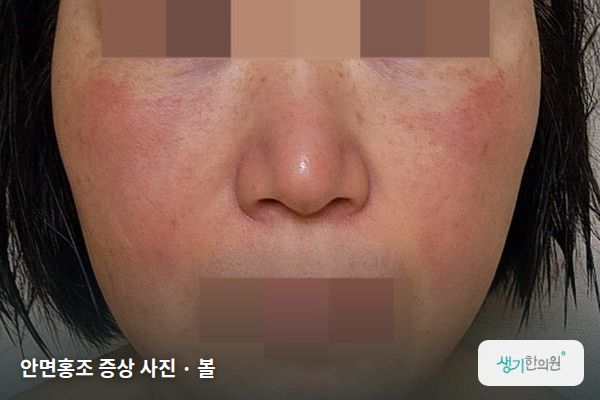 볼에 생긴 안면홍조 증상 사진 — 안면홍조 증상 사진 · 볼