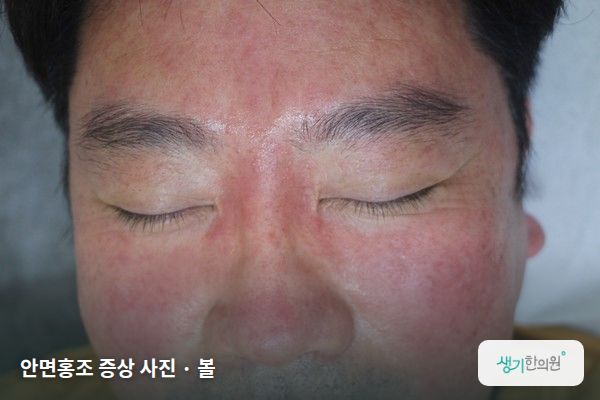 볼에 생긴 안면홍조 증상 사진 — 안면홍조 증상 사진 · 볼