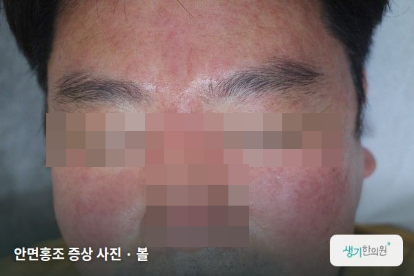 볼에 생긴 안면홍조 증상 사진 — 안면홍조 증상 사진 · 볼