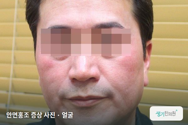 얼굴에 생긴 안면홍조 증상 사진