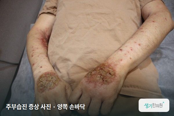 양쪽 손바닥에 생긴 주부습진 증상 사진 — 주부습진 증상 사진 · 양쪽 손바닥