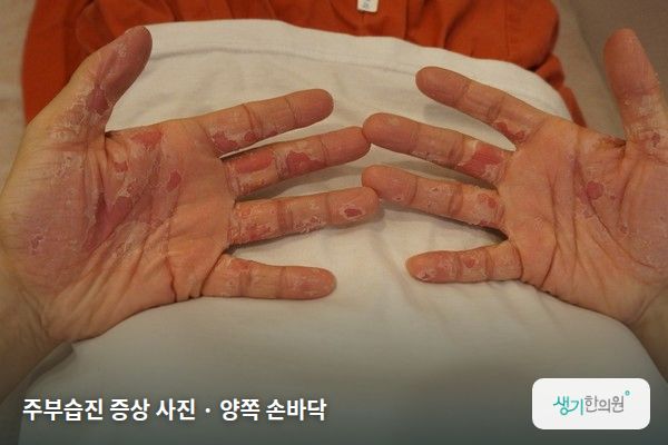 양쪽 손바닥에 생긴 주부습진 증상 사진 — 주부습진 증상 사진 · 양쪽 손바닥
