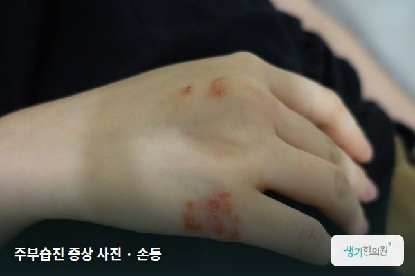 손등에 생긴 주부습진 증상 사진 — 주부습진 증상 사진 · 손등