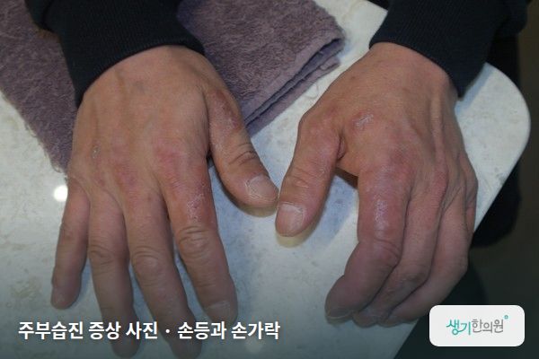 손등과 손가락에 생긴 주부습진 증상 사진 — 주부습진 증상 사진 · 손등과 손가락