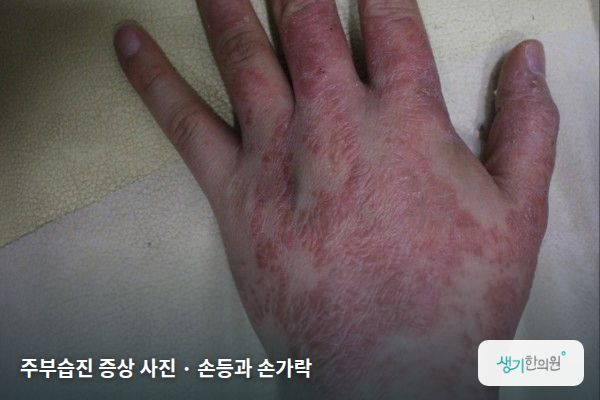 손등과 손가락에 생긴 주부습진 증상 사진 — 주부습진 증상 사진 · 손등과 손가락