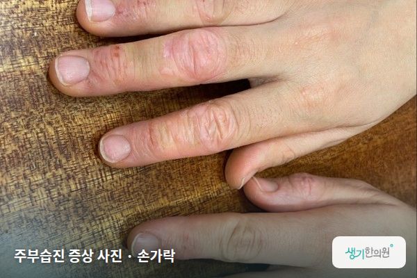 손가락에 생긴 주부습진 증상 사진 — 주부습진 증상 사진 · 손가락