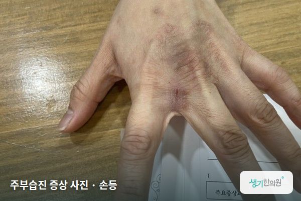 손등에 생긴 주부습진 증상 사진 — 주부습진 증상 사진 · 손등