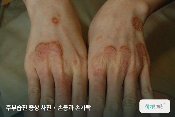 손등과 손가락에 생긴 주부습진 증상 사진 — 주부습진 증상 사진 · 손등과 손가락