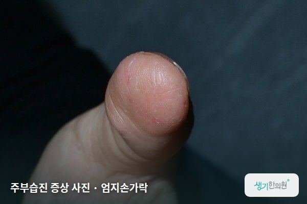 엄지손가락에 생긴 주부습진 증상 사진 — 주부습진 증상 사진 · 엄지손가락