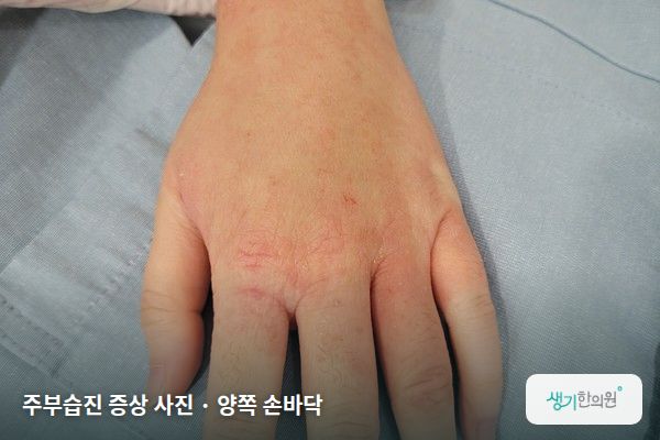 양쪽 손바닥에 생긴 주부습진 증상 사진 — 주부습진 증상 사진 · 양쪽 손바닥