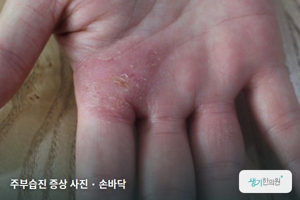손바닥에 생긴 주부습진 증상 사진 — 주부습진 증상 사진 · 손바닥