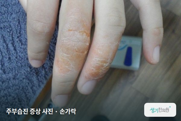 손가락에 생긴 주부습진 증상 사진 — 주부습진 증상 사진 · 손가락