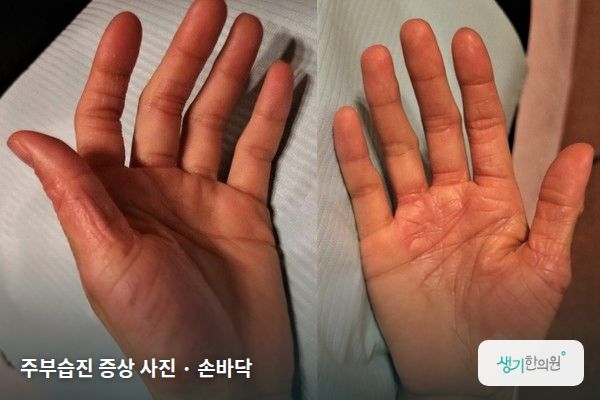 손바닥에 생긴 주부습진 증상 사진